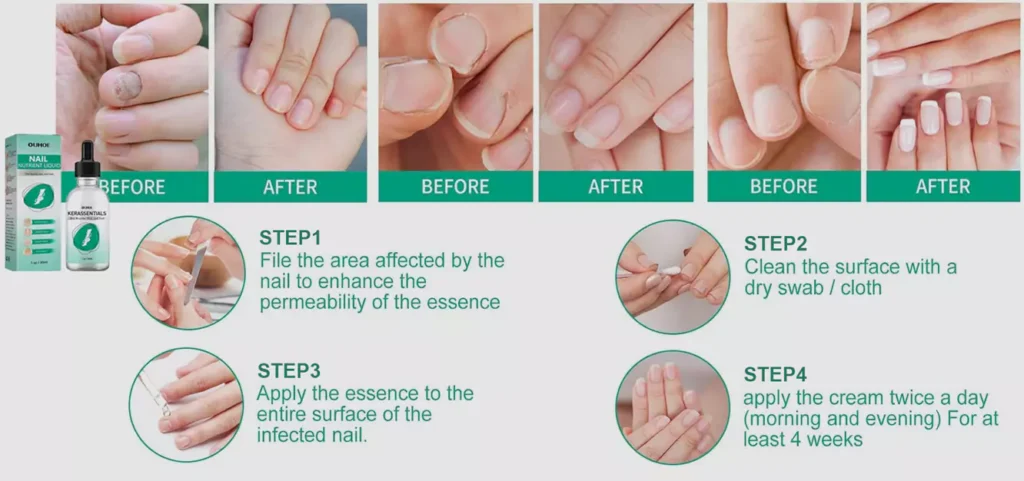 Toenail Fungus use